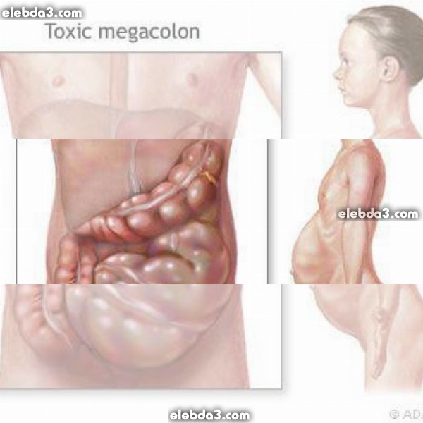 مقال: انتفاخ و تورم بطن الطفل | امراض جهاز الهضم عند الأطفال