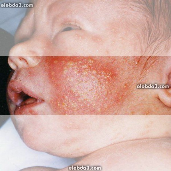 مقال: الأمراض الجلدية التي تصيب الأطفال حديثي الولادة | الامراض الجلدية عند الأطفال - امراض الجلد 