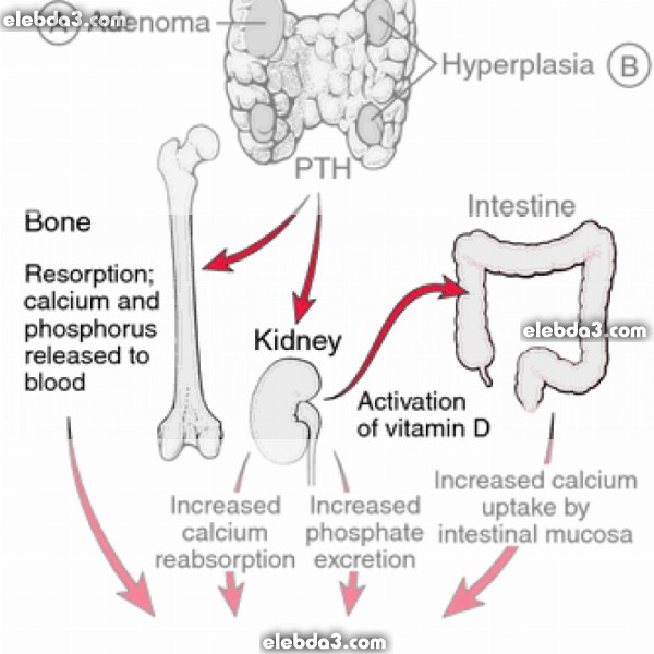 مقال عن أسباب ارتفاع الكالسيوم عند الأطفال والرضع وحديثي الولادة