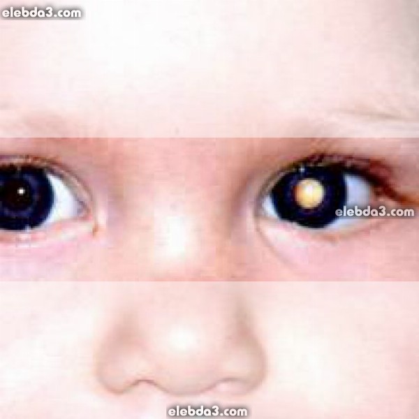 مقال: الحدقة البيضاء عند الأطفال :اسباب , اعراض , علاج | امراض العيون عند الاطفال 