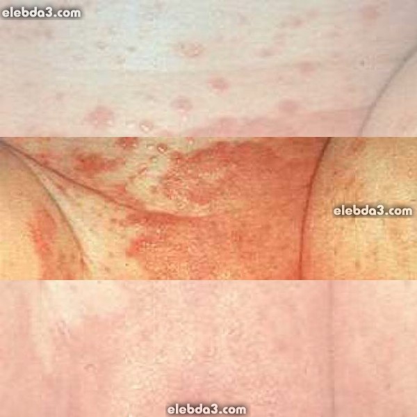 مقال: التهاب جلد الحفاظ تحت الفوطة | الامراض الجلدية عند الأطفال - امراض الجلد 