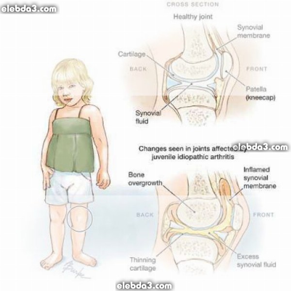 مقال: العرج عند الاطفال | امراض العظام عند الاطفال 
