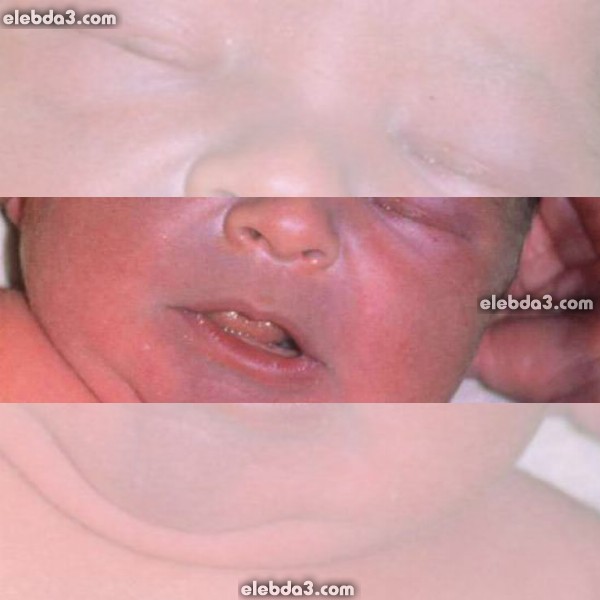 مقال: ازرقاق الطفل حديث الولادة عند الولادة | امراض القلب المزرقة عند الاطفال 