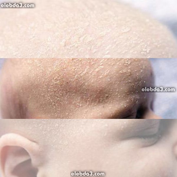 مقال: خبزة الراس- خبز الرأس | الامراض الجلدية عند الأطفال - امراض الجلد 