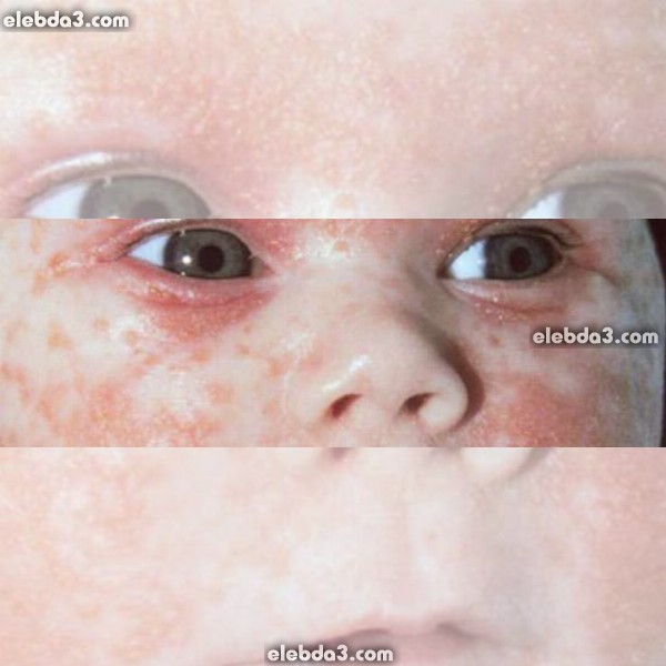 مقال: التهاب الجلد الدهني عند الأطفال و الرضع | الامراض الجلدية عند الأطفال - امراض الجلد 