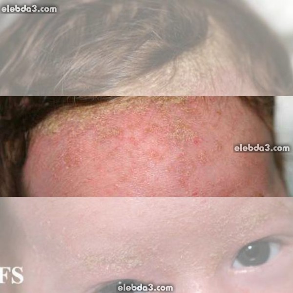 مقال: الأكزيما الدهنية عند الأطفال و الرضع | الامراض الجلدية عند الأطفال - امراض الجلد 