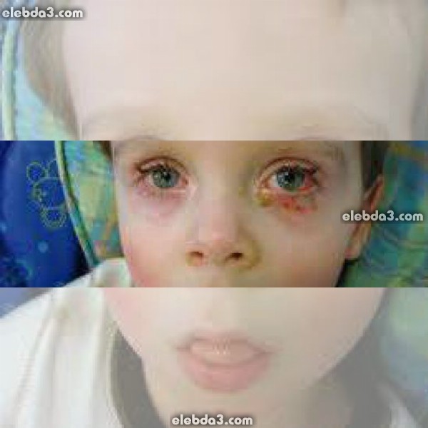 مقال: التهاب الملتحمة عند الرضع | امراض العيون عند الاطفال 