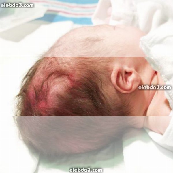 مقال: حدبة مصلية دموية عند طفل حديث الولادة | الأطفال حديثي الولادة 