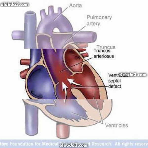 مقال: الجذع الشرياني | امراض القلب المزرقة عند الاطفال 