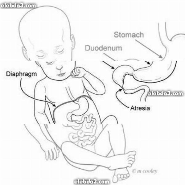 مقال: انسداد و رتق و تضيق العفج الولادي | أمراض الطفل حديث الولادة 