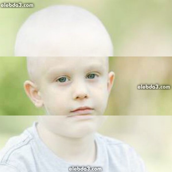 مقال: ورم ويلمس عند الرضع و الأطفال | الأورام و السرطان عند الأطفال