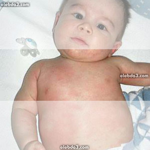 مقال انزعاج الطفل الرضيع من الحليب أمراض الحساسية عند الأطفال