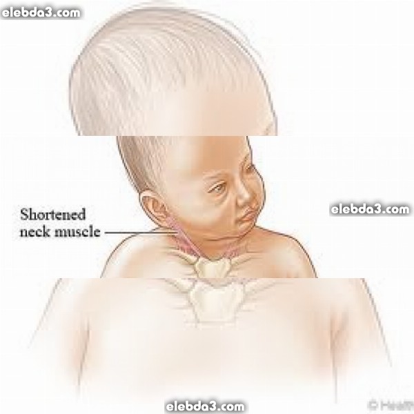 مقال: الصعر و ميلان رأس الطفل حديث الولادة نحو احد الجانبين | أمراض الطفل حديث الولادة 