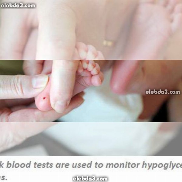 مقال: نقص السكر في الدم عند الأطفال حديثي الولادة | أمراض الطفل حديث الولادة 