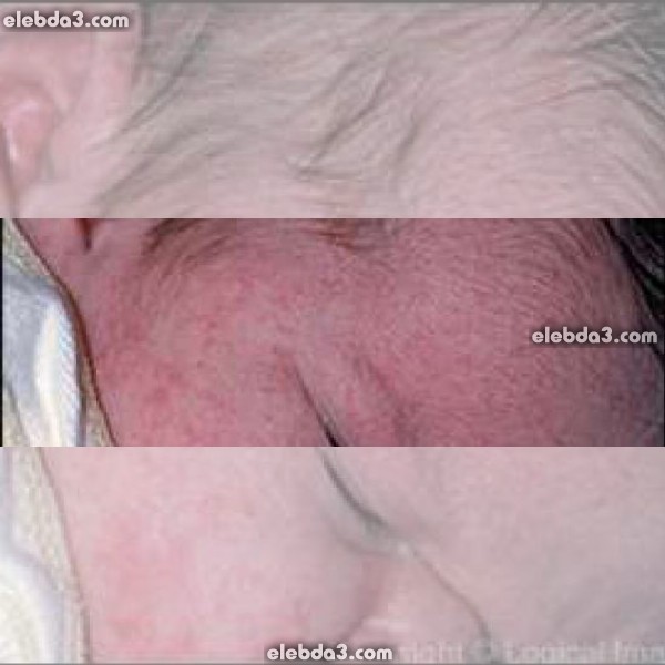 مقال: جلد الطفل عند ولادته | الأطفال حديثي الولادة 