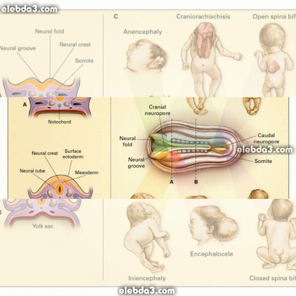 مقال: تشوهات الجهاز العصبي عند الأطفال حديثي الولادة | الامراض العصبية عند الاطفال 