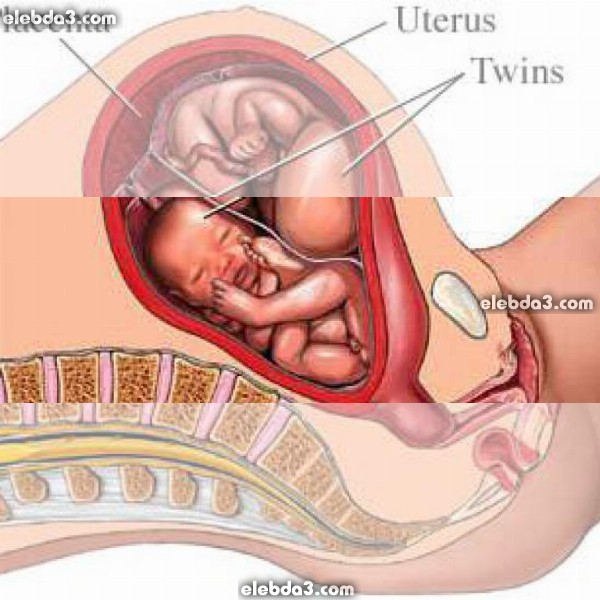 مقال: مشاكل حامل التوأم | مشاكل الحمل 