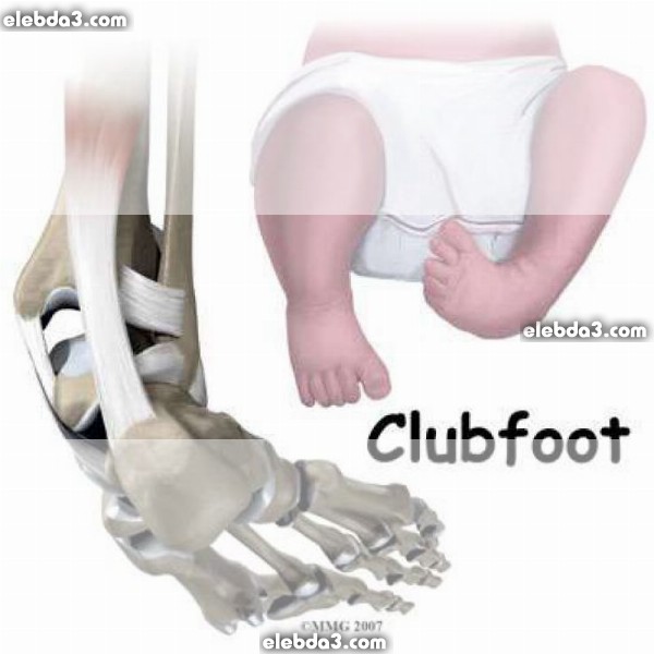 مقال: القدم الحنفاء | أمراض و تشوهات القدم عند الأطفال 