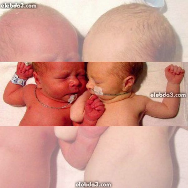 مقال: ارتفاع هيموجلوبين الدم عند الأطفال حديثي الولادة | أمراض الطفل حديث الولادة 