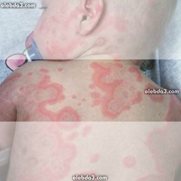 مقال: الحمامى متعددة الأشكال | الامراض الجلدية عند الأطفال - امراض الجلد 