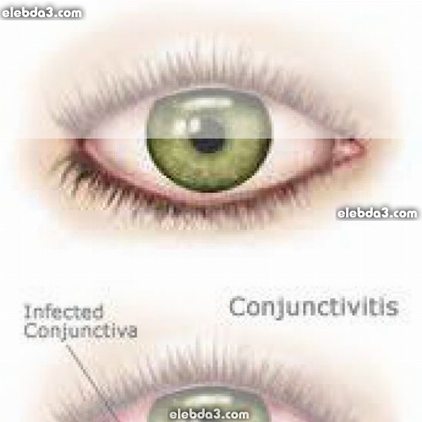 مقال: التهاب العين و الملتحمة للاطفال | امراض العيون عند الاطفال 