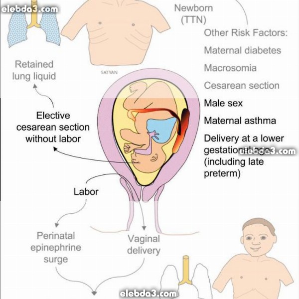 مقال: الزلة التنفسية عند حديثي الولادة | أمراض الطفل حديث الولادة 