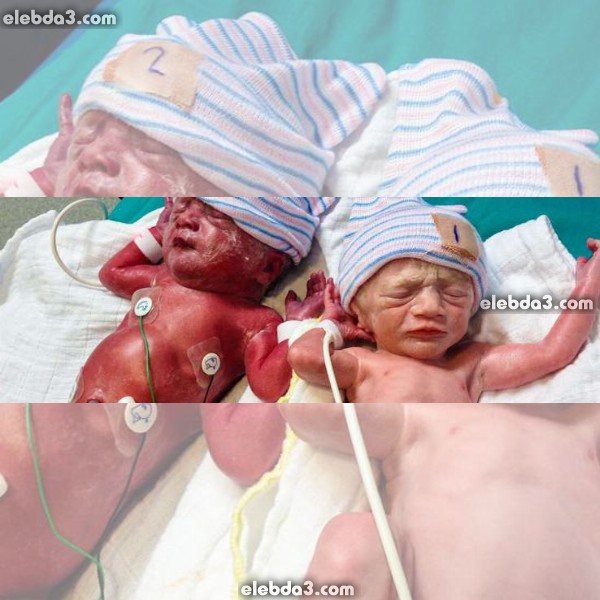 مقال: الأنيميا و فقر الدم عند الأطفال حديثي الولادة | أمراض الطفل حديث الولادة 
