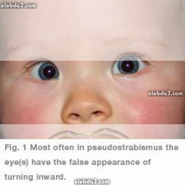 مقال: حول الأطفال و الرضع | امراض العيون عند الاطفال