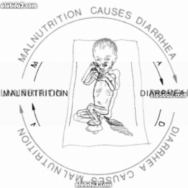 مقال: الإسهال و الجفاف لدى الأطفال المصابين بسوء التغذية المزمن | امراض جهاز الهضم عند الأطفال 