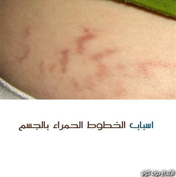 مقال: الخطوط الحمراء بالجسم وأسبابها | الامراض الجلدية 