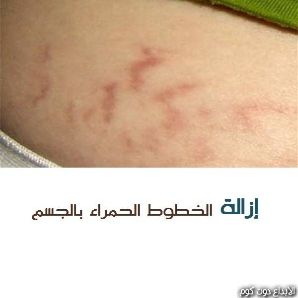 مقال: إزالة الخطوط الحمراء من الجسم | الامراض الجلدية 