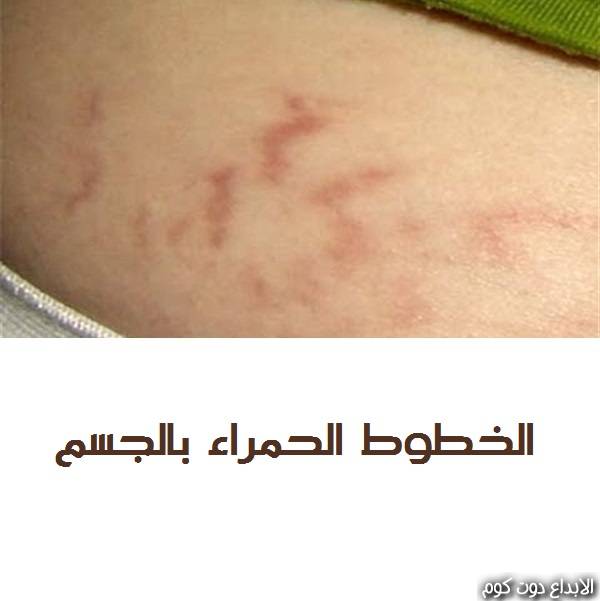 مقال: الخطوط الحمراء بالجسم | الامراض الجلدية 