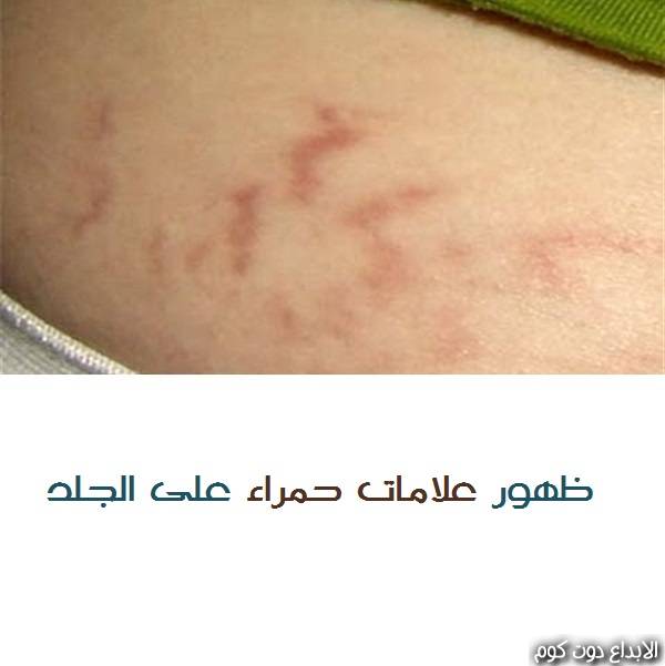 مقال: ظهور خطوط حمراء على الجلد | الامراض الجلدية 