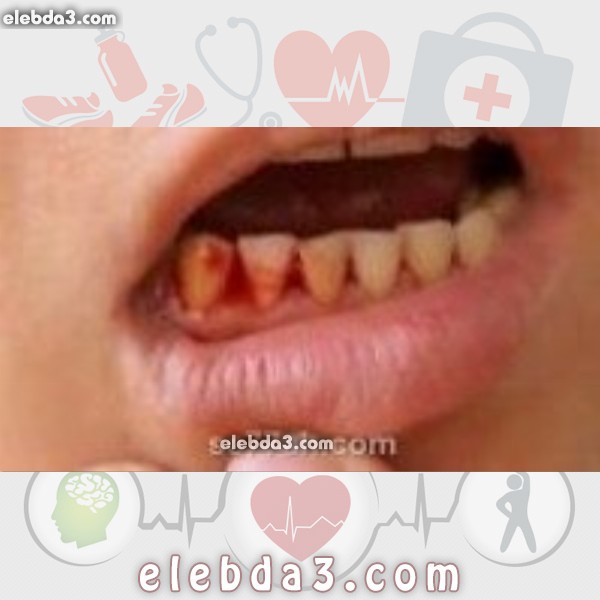 مقال: ما هي أسباب خروج الدم من الفم | الفم و الاسنان 