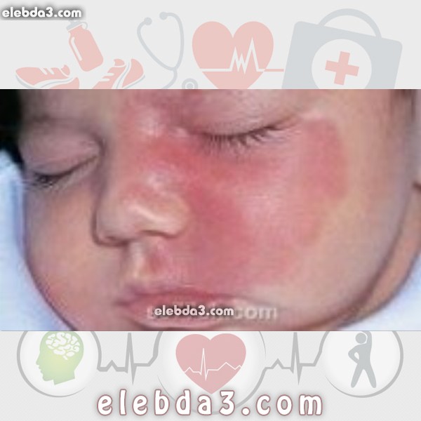 مقال ظهور بقع حمراء على الوجه الامراض الجلدية