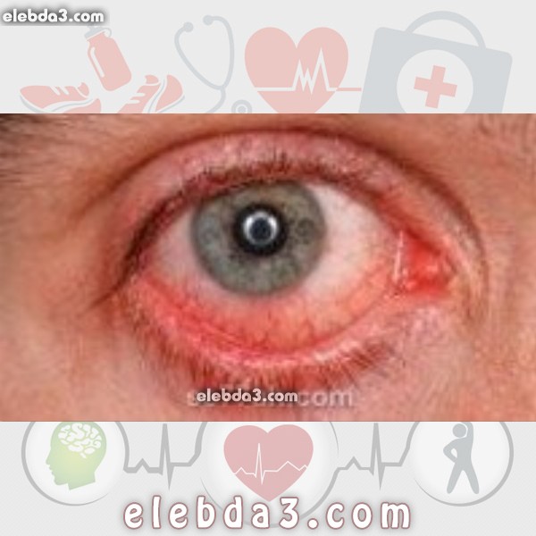 مقال: كيف تعالج احمرار العين | امراض العيون 