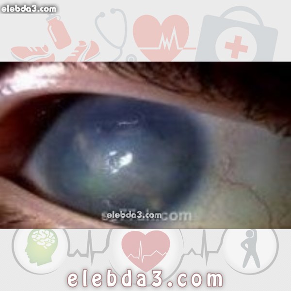 مقال: أعراض المياه الزرقاء | امراض العيون 