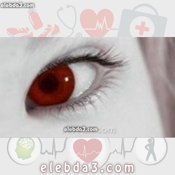 مقال: العين الحمراء | امراض العيون 