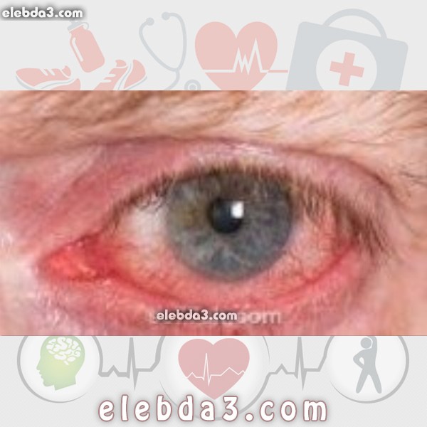 مقال: المياه الزرقاء في العين | امراض العيون 