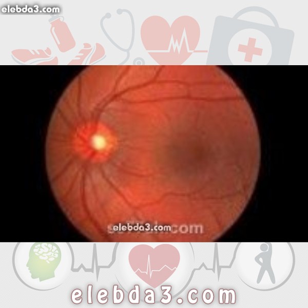 مقال: التهاب العصب البصري | امراض العيون 