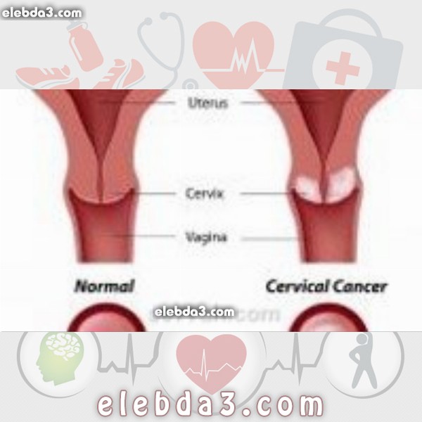 مقال: أعراض سرطان الرحم | السرطان 